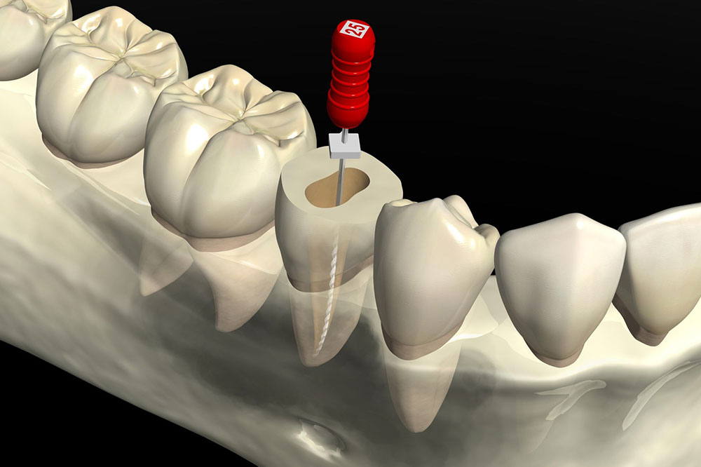 根管治療