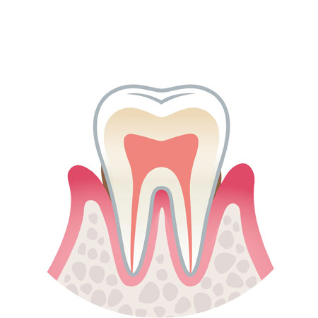 軽度歯周炎